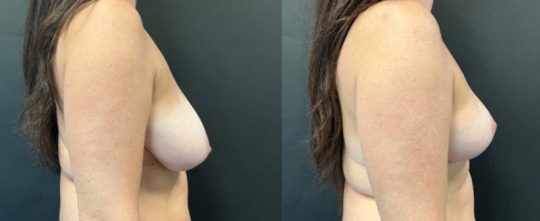 Side view of a female patient before and 1 month after Breast Reduction