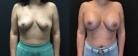 Front view of a female patient before and after Breast Augmentation procedure