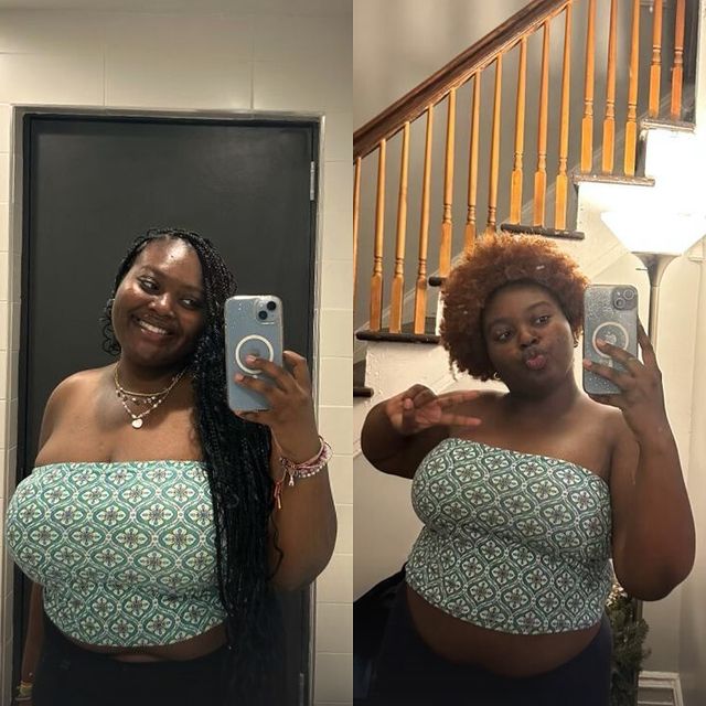 Have you ever wondered if you are too young for a Breast Reduction? Our 19-year-old patient underwent a stunning breast transformation under our care just three weeks ago, and she is absolutely loving it!