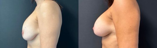 female patient before and after Implant exchange/ mastopexy