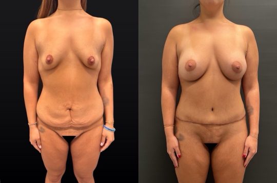 Front view before and after abdominoplasty with liposuction to the flanks and mons, Morpheus8 to the mons, and bilateral breast augmentation with 415cc Sientra implants (dual-plane technique).