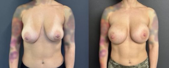 Before and after bilateral breast augmentation in a 34-year-old female with 350cc and 280cc Sientra implants placed in a subglandular position.