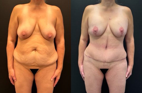 Before and 3 months after abdominoplasty, liposuction to flanks and mons mastopexy augmentation 385 cc sientra