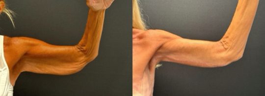 Before and after brachioplasty and arm liposuction in a 63-year-old female at 3 months post-op showing improved contour and reduced excess skin