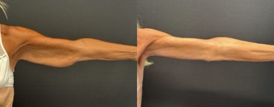 Before and after brachioplasty and arm liposuction in a 63-year-old female at 3 months post-op showing improved contour and reduced excess skin