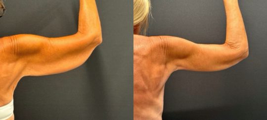 Before and after brachioplasty and arm liposuction in a 63-year-old female at 3 months post-op showing improved contour and reduced excess skin