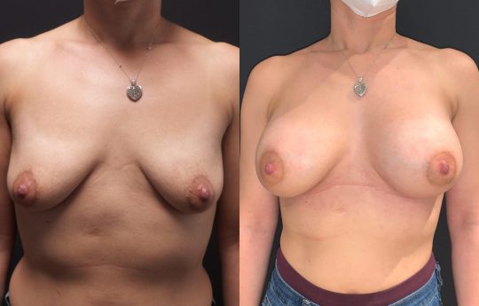 front view of a female patient before and after Breast Augmentation with 375cc Implants