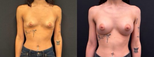 efore and 6month post op 300cc sientra, high profile, submuscular
