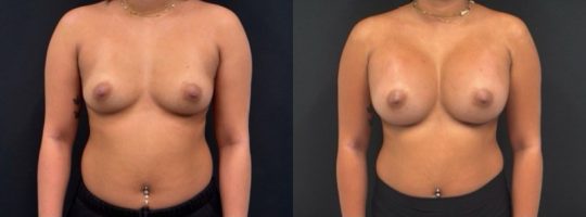 before and 1 month post op 505 sientra Moderate plus, submuscular
