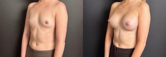 patient before and one month post-op Sientra 305 Moderate Plus, Submuscular