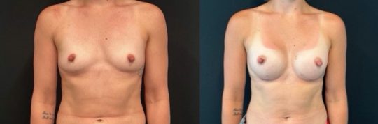 patient before and one month post-op, Motiva 245, Subglandular