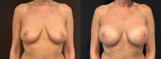 patient before and one month post-op Sientra 385 High Profile, Subglandular