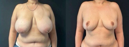 patient before and one year post bilateral breast reduction