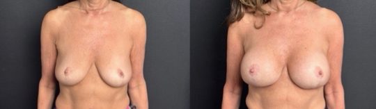 patient before and one month Post-op, 305 Sientra Moderate Plus, Subglandular