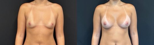 20 yo patient before and after breast augmentation with 300cc Sientra High Profile, Submuscular